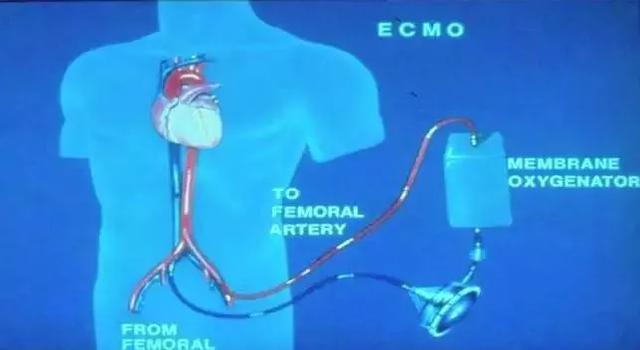 答案来了!加拿大白求恩医学发展协会为什么要捐ECMO(人工心肺机)及耗材